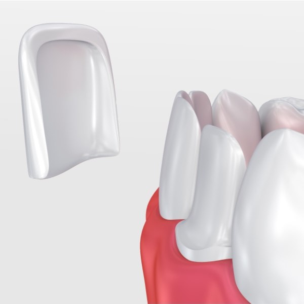 Composite Resin Veneers