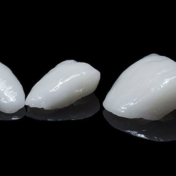 Porcelain Veneers