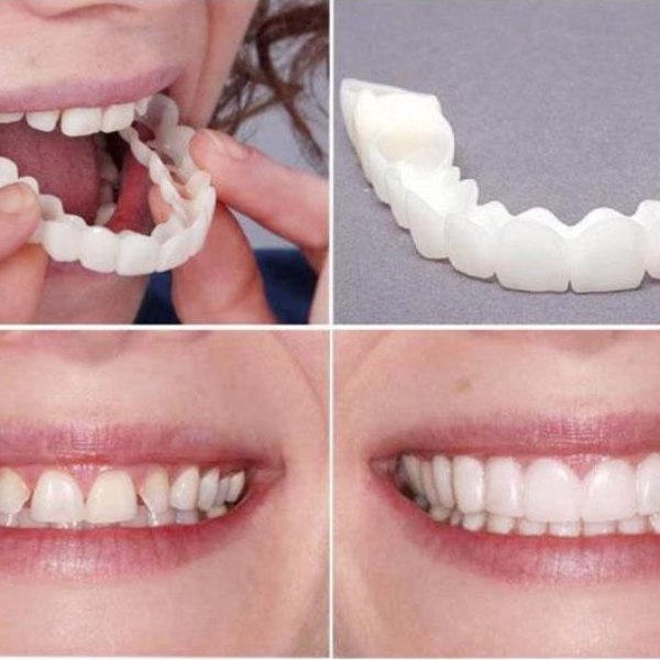 Removable Veneers