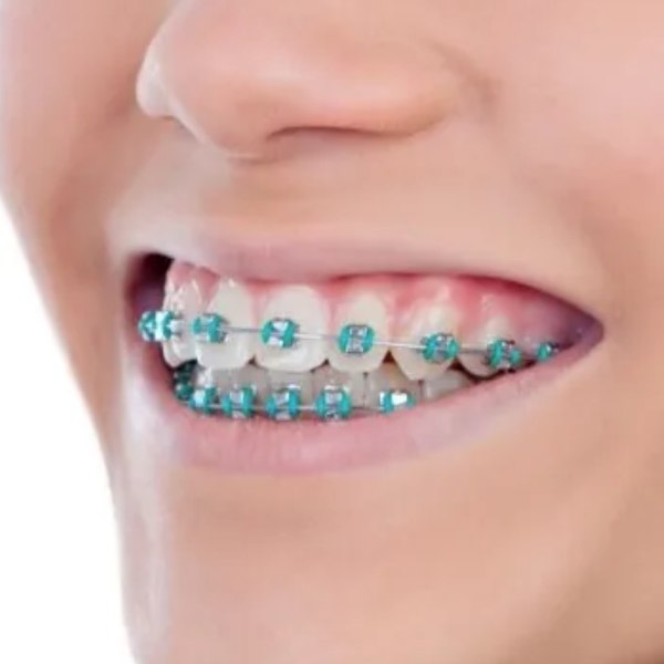 Self-Ligating Braces