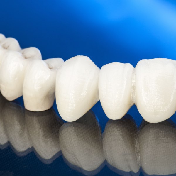 Row of all-ceramic crowns, a metal-free option discussed in biocompatible dentistry
