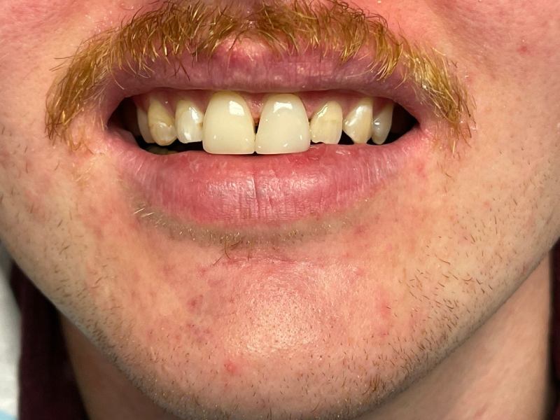 after-veneer Dental Veneers in North York