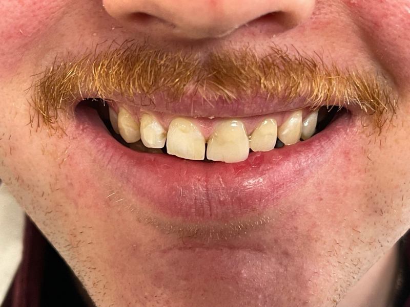 before-veneer Dental Veneers in North York