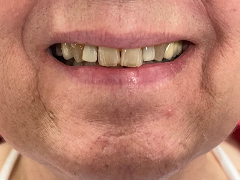 veneer-before Dental Veneers in North York