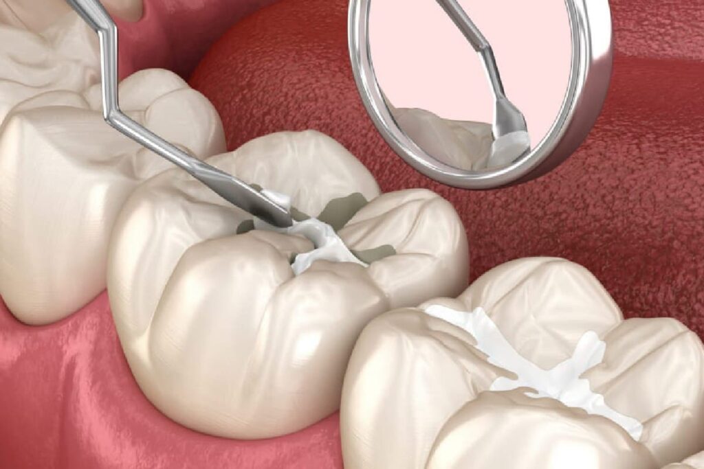 Dental Sealants