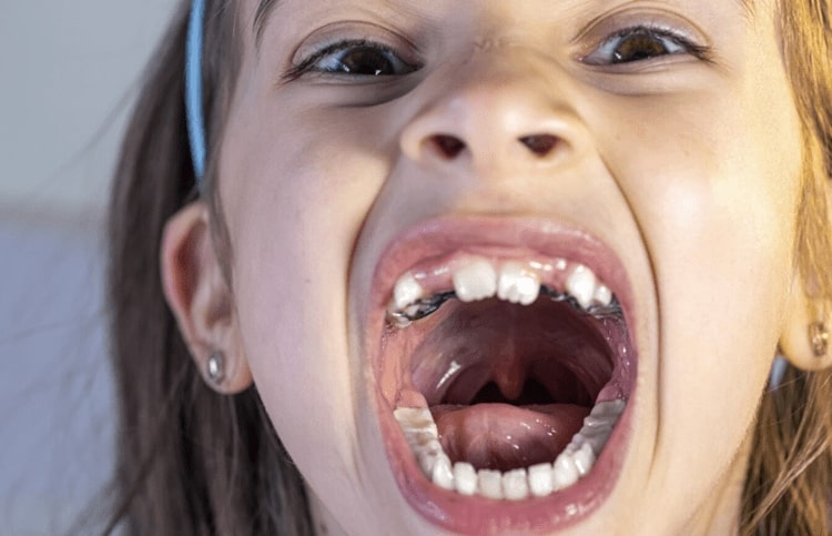 Cavities in Baby Teeth