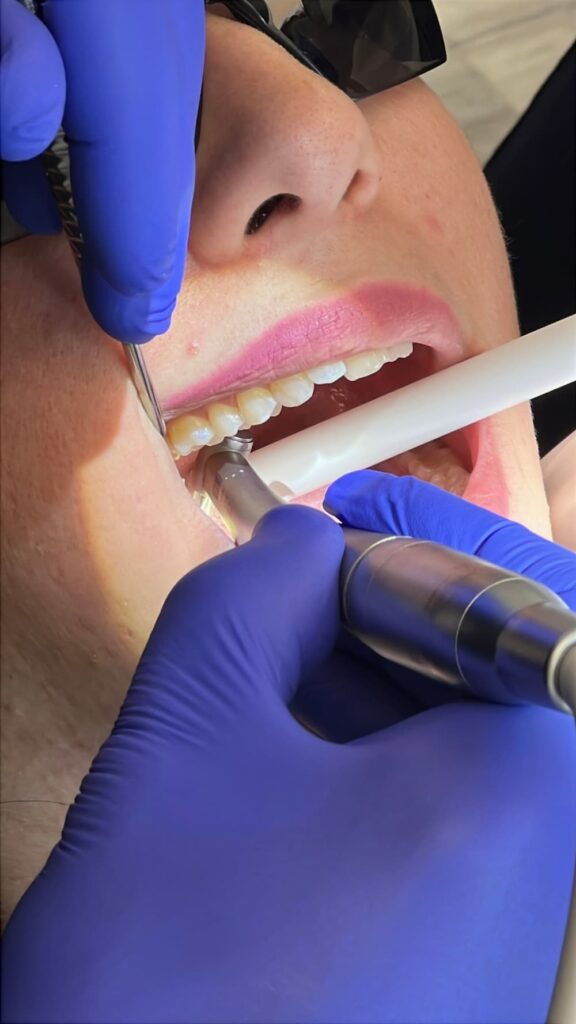 Emergency Tooth Extraction in North York