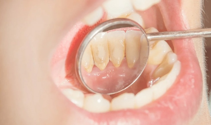 Plaque buildup and its impact on teeth