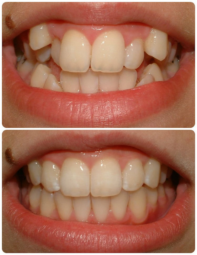 before and after of fixing crooked teeth