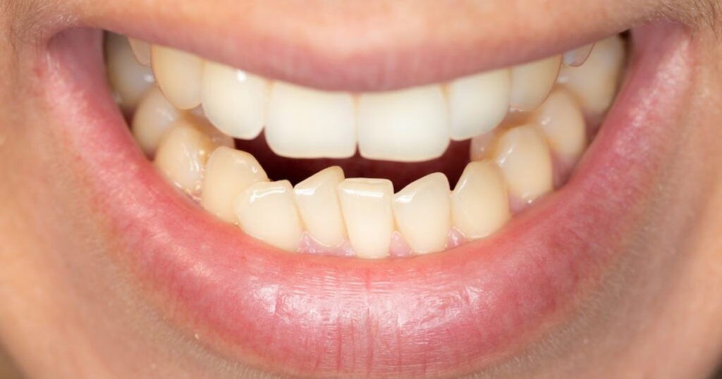Top 5 Cosmetic Dentistry Options for Crooked Teeth