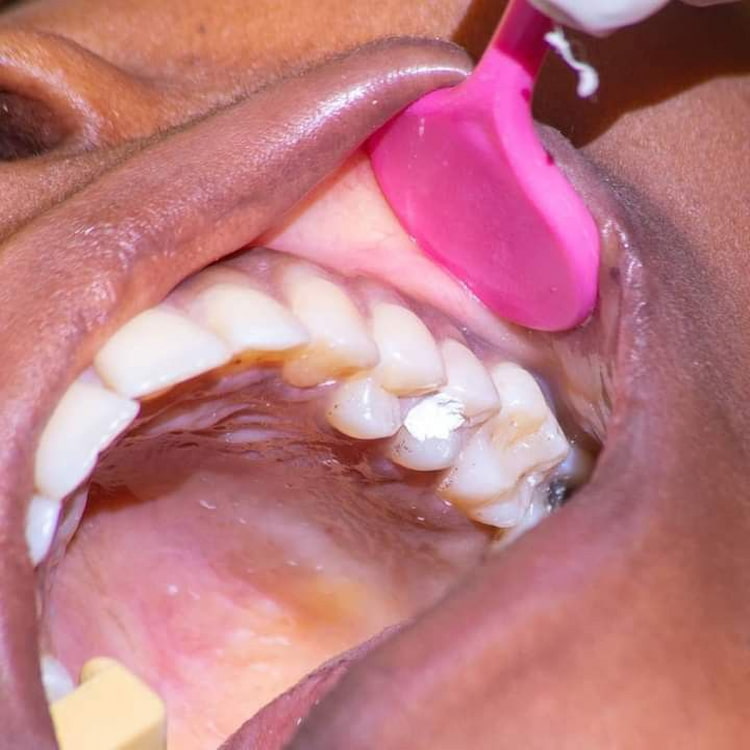 an open mouth which has a temporary tooth filling on one of the teeth.