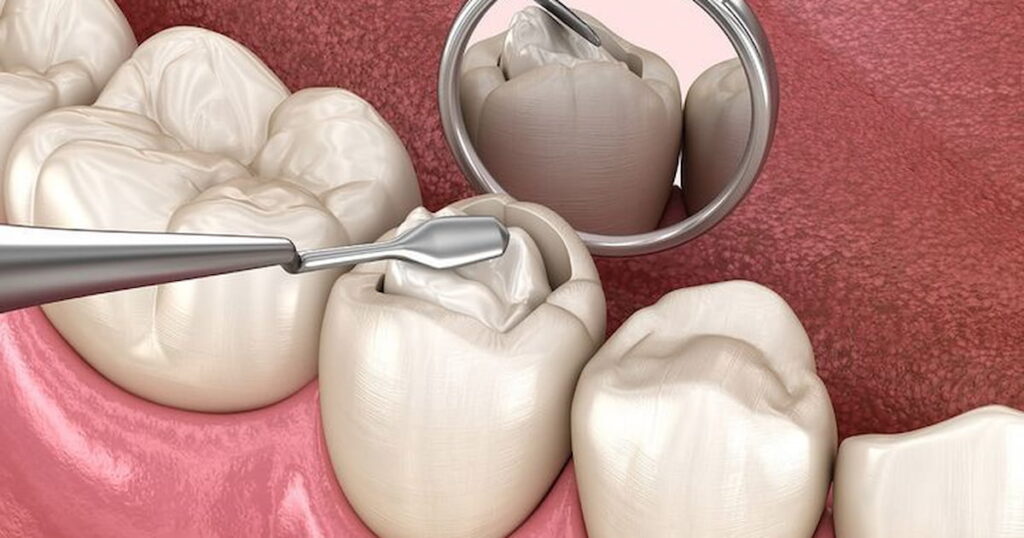 Temporary tooth fillings being applied for a tooth.