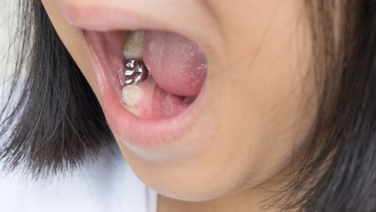 a person has opened her mouth and her amalgam dental filling is shown.