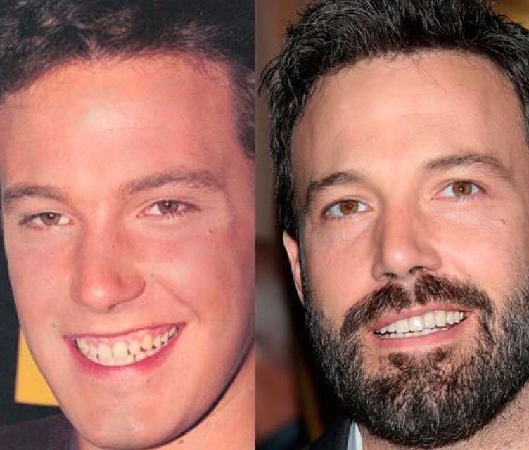 Ben Affleck before and after dental veneers