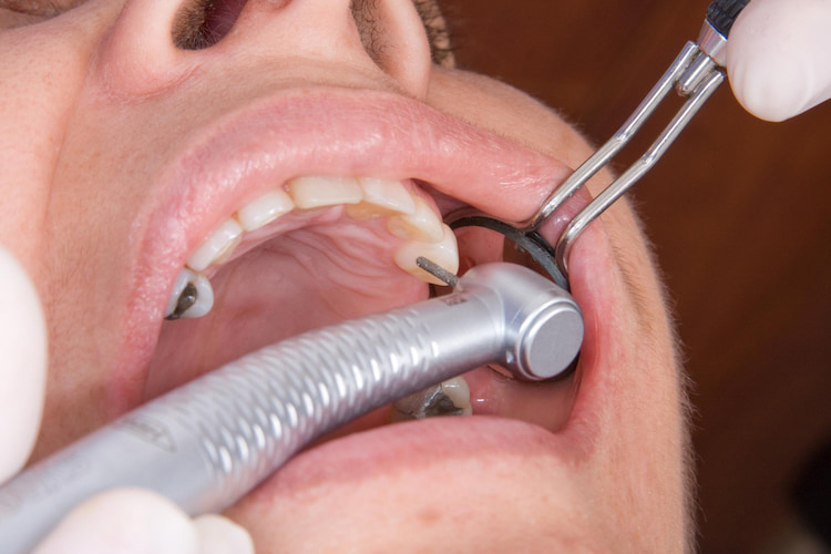 a patient's teeth are being drilled during the dental filling treatment process.