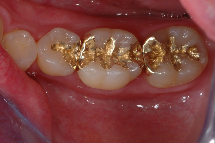 three teeth with gold dental fillings applied on them.