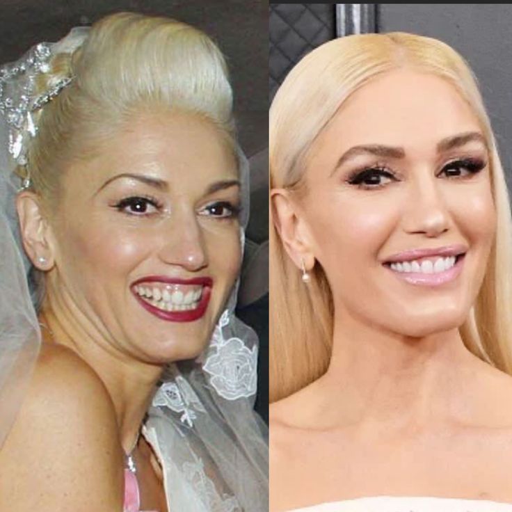 Gwen Stefani before and after dental veneers