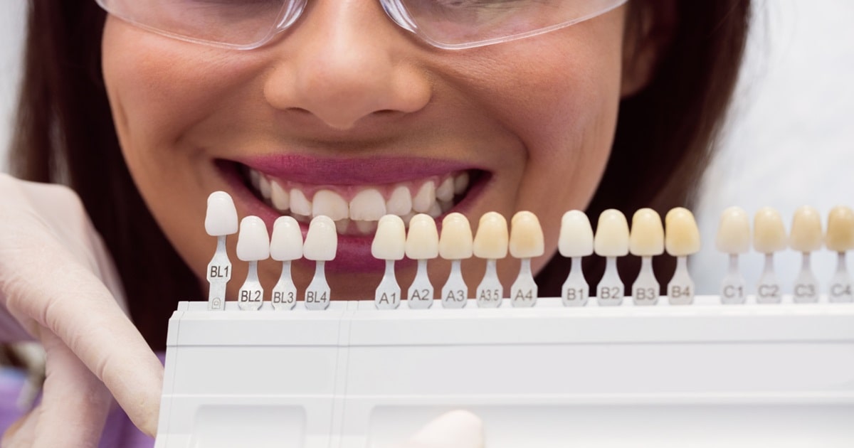 How Teeth Are Prepped for Veneers