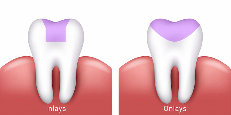 two teeth showing which part inlays and onlays cover.