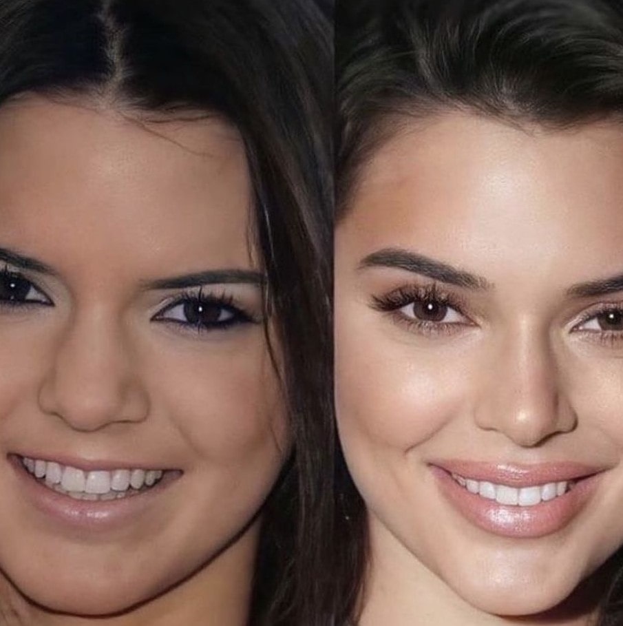 Kendal Jenner before and after dental veneers
