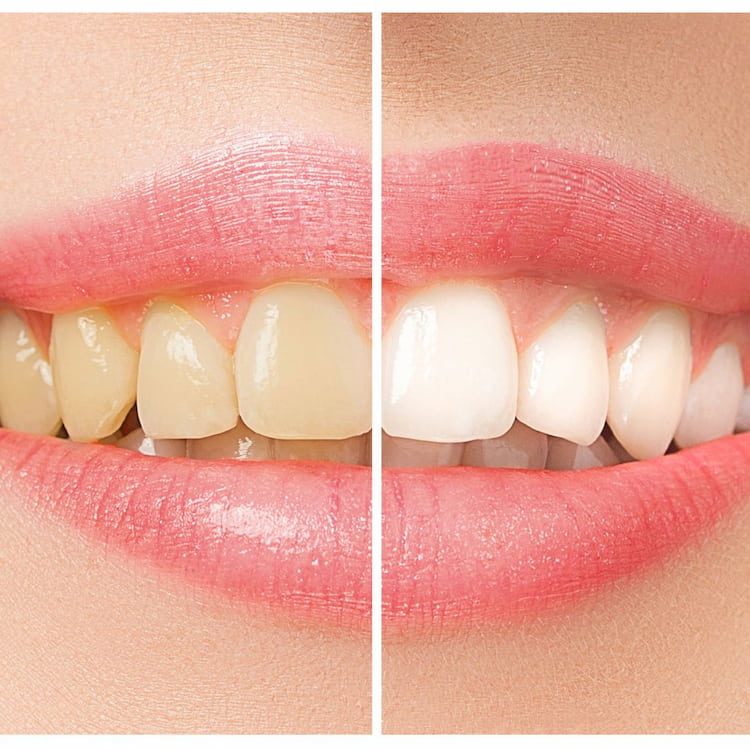 before and after of professional teeth whitening 