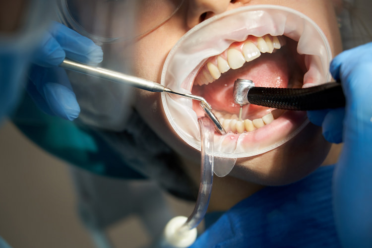 a dentist drilling tooth for a patient during dental filling treatment.
