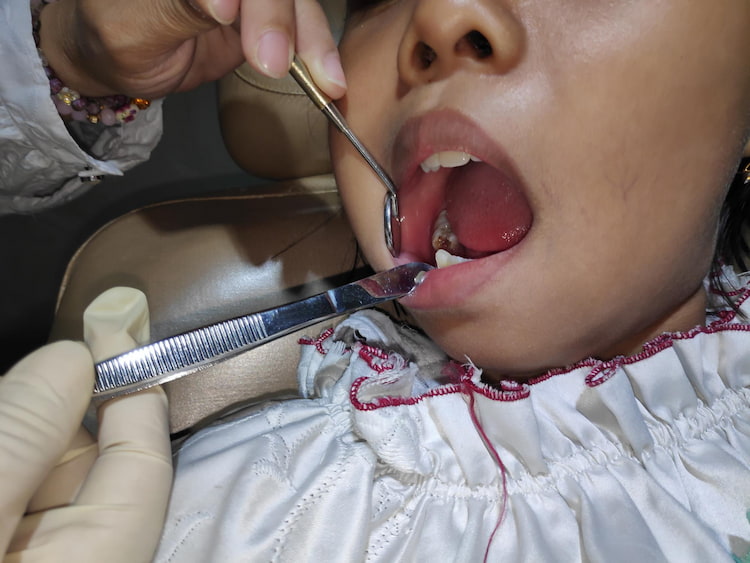 a dentist is opening a patient's mouth to treat infection after tooth extraction.