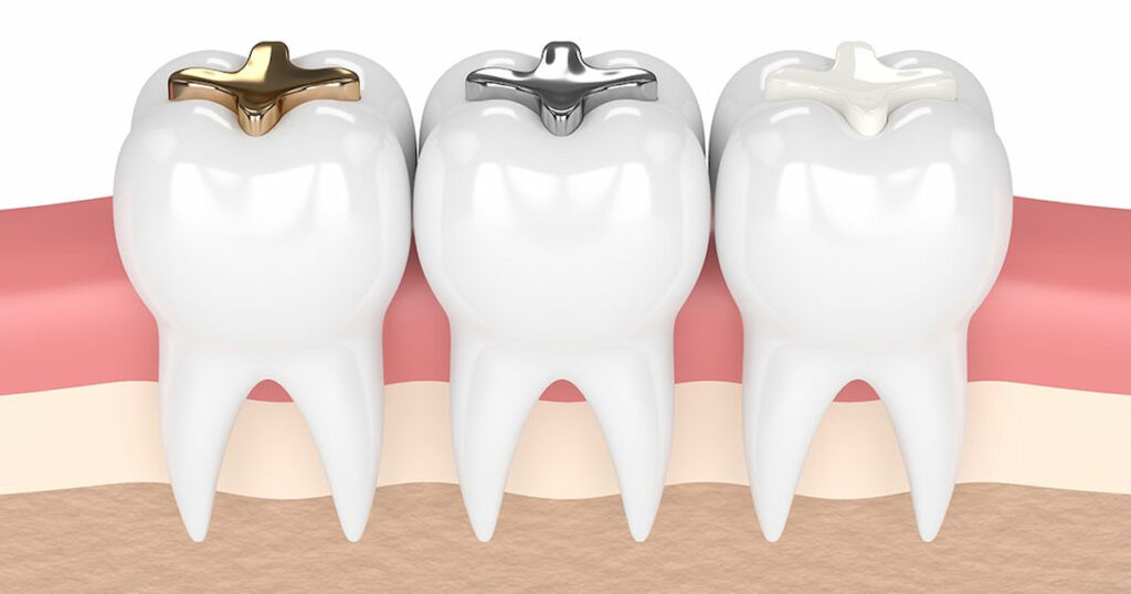 types of dental filling materials in three teeth next to each other.