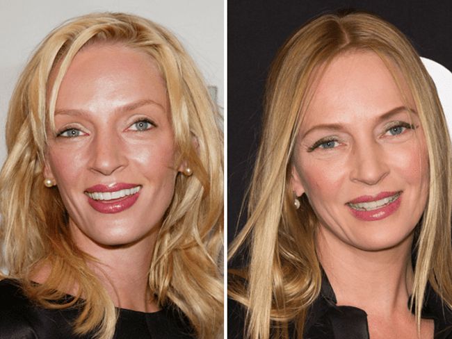 Uma Thurman before and after veneers