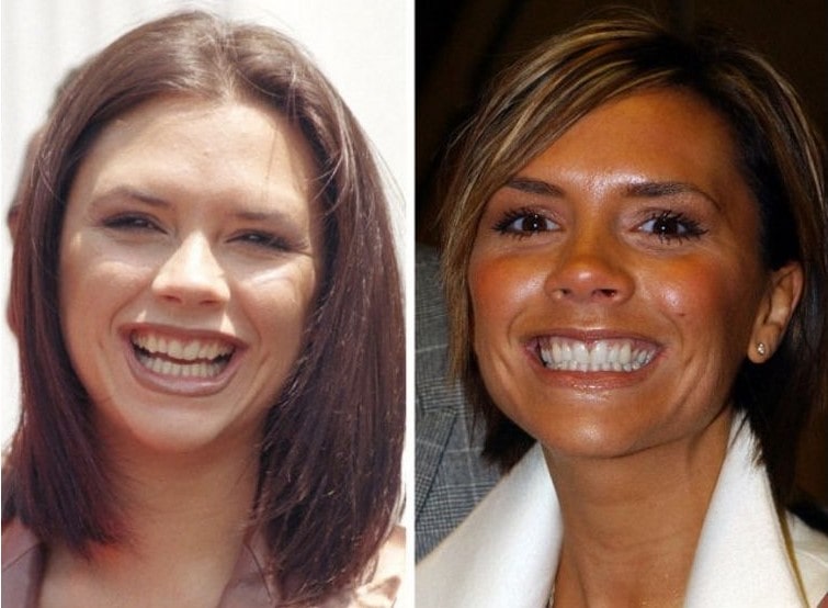 Victoria Beckham before and after dental veneers