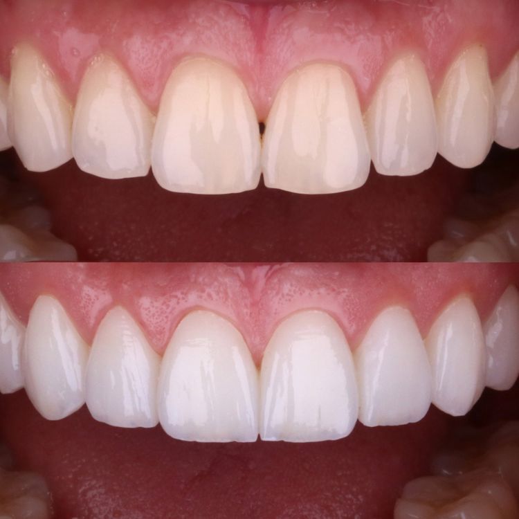 before and after of whitening teeth with dental veneers.