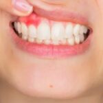 Gum Disease Treatment
