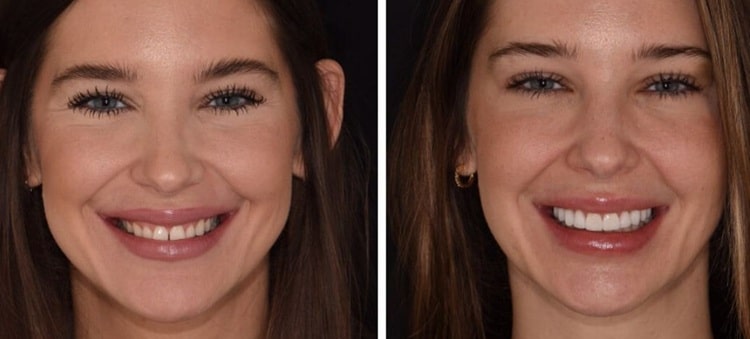No-Prep Veneers before and after