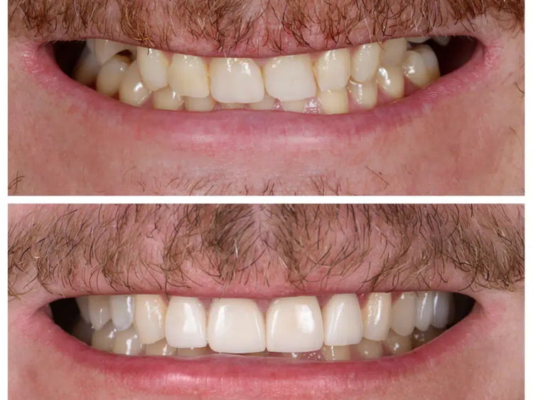 before and after porcelain veneers