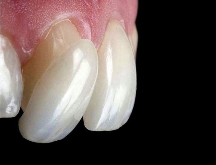 Porcelain Veneers