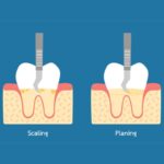 Scaling and Root Planing