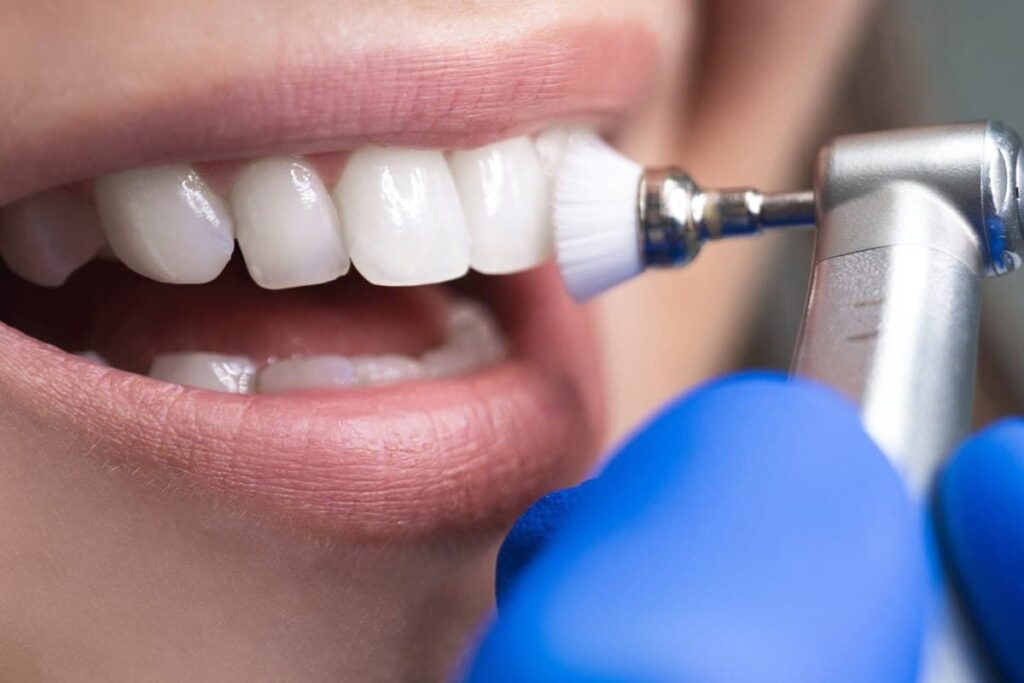 Teeth Polishing