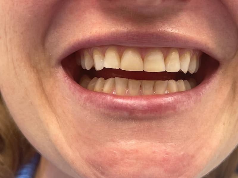 Veneers0 Color correction