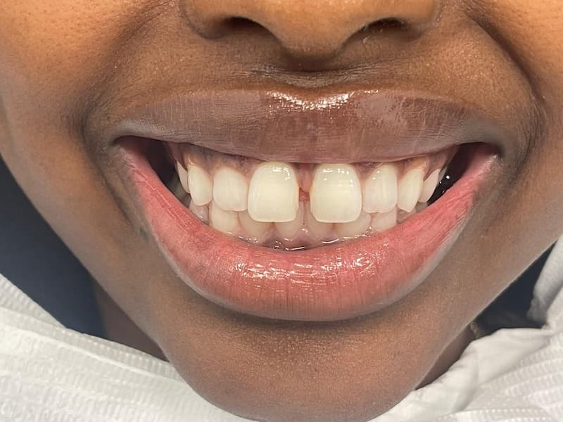 Veneers02 Gap Closure