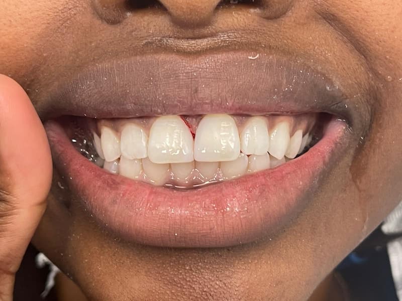 Veneers03 Gap Closure