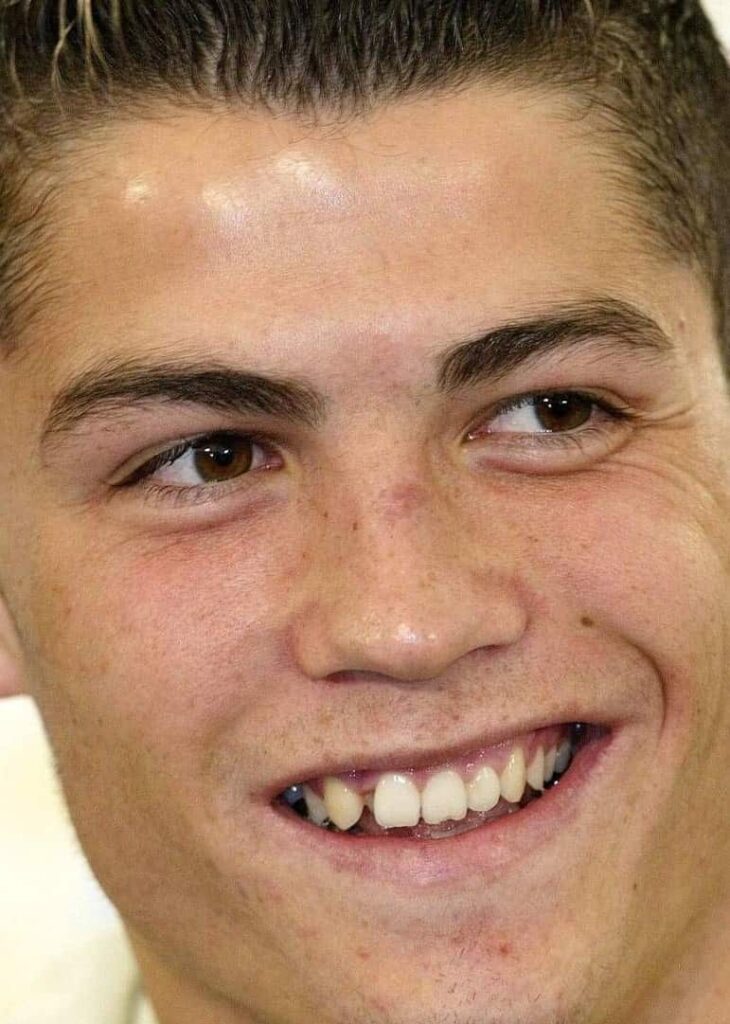 Cristiano Ronaldo before veneers