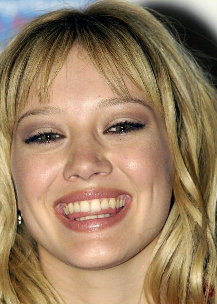 Hilary Duff before dental veneers