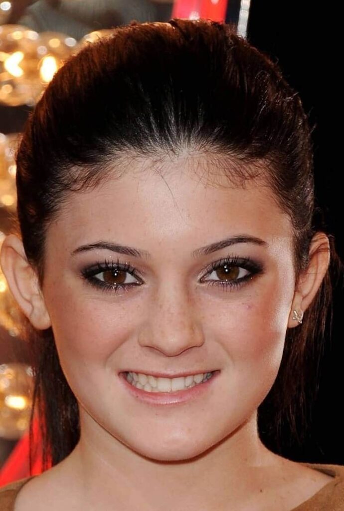 Kylie Jenner before dental veneers