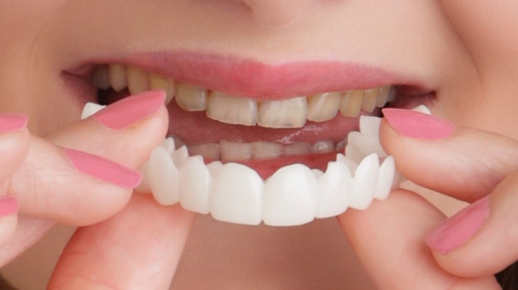removable dental veneers