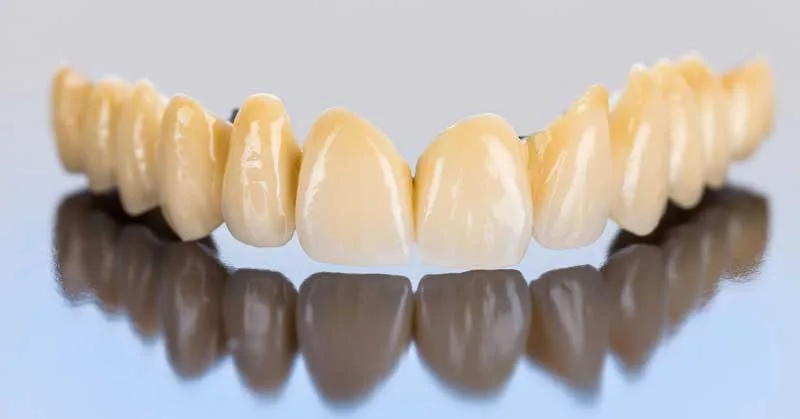 Staining or dulling of veneers