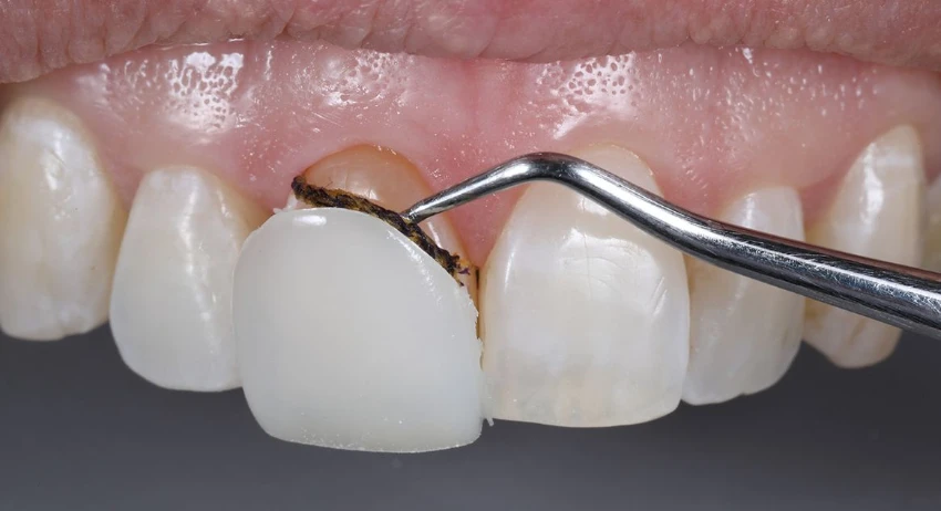 Removing the Veneer Material by a dentist
