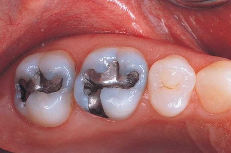Amalgam (Silver) Fillings