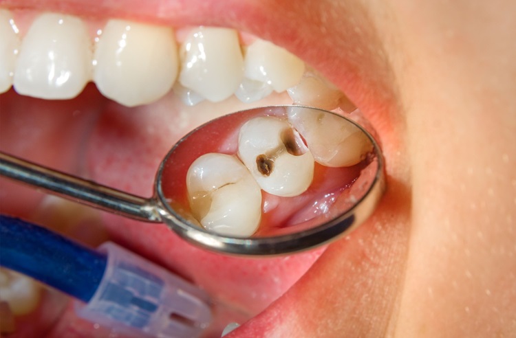 dental cavities 