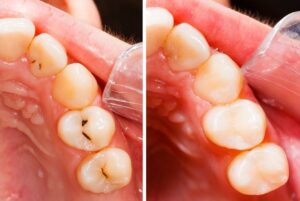 Before-and-after close-up of tooth-coloured composite restorations