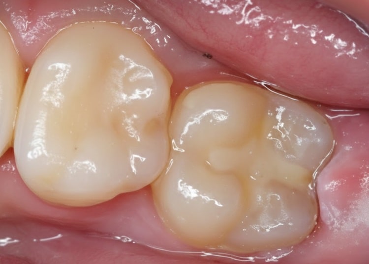 Glass dental fillings